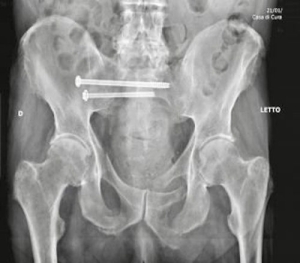 Politrauma da investimento stradale con frattura dell’anello pelvico
